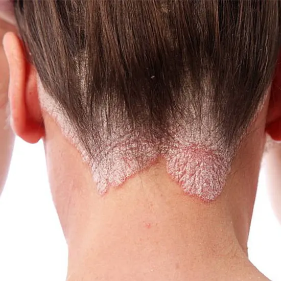 A Healthy Scalp Is A Happy Scalp : Say Goodbye To Tinea Capitis